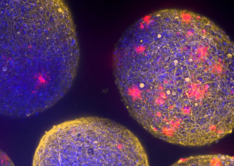 Il ritorno di bavisant nella ricerca sulla sclerosi multipla