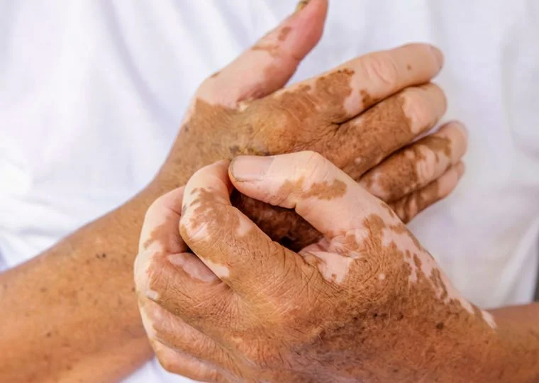 Dalla genetica agli inibitori di JAK: come la ricerca sta cambiando la comprensione della vitiligine