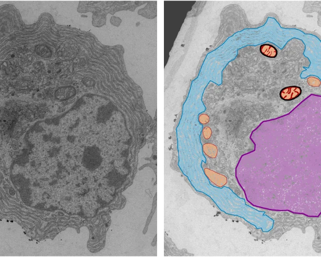 Amiloidosi: una ricerca UniSR scopre il tallone d'Achille delle plasmacellule killer