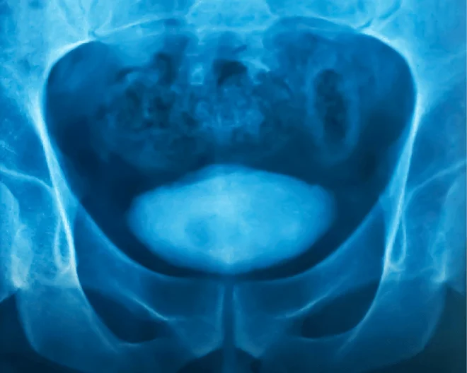Gold nanoparticles: from San Raffaele research the new frontier to identify and eliminate until now invisible bladder tumors