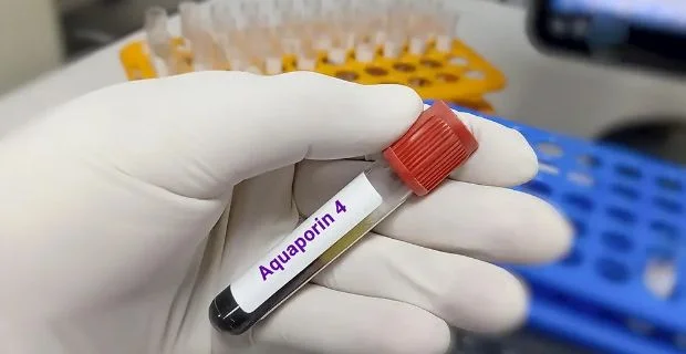 Neuromielite ottica: il trapianto allogenico di cellule staminali ematopoietiche tiene a bada la malattia