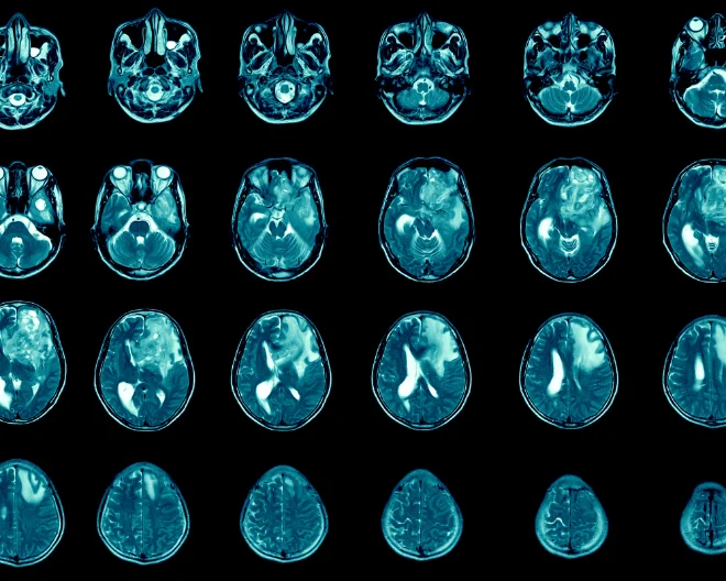 Una nuova piattaforma di terapia genica per il glioblastoma multiforme
